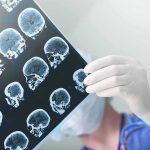 Hidden Brain Injuries Take Center Stage in Veteran Suicide Fight Doctor holding brain MRI scans